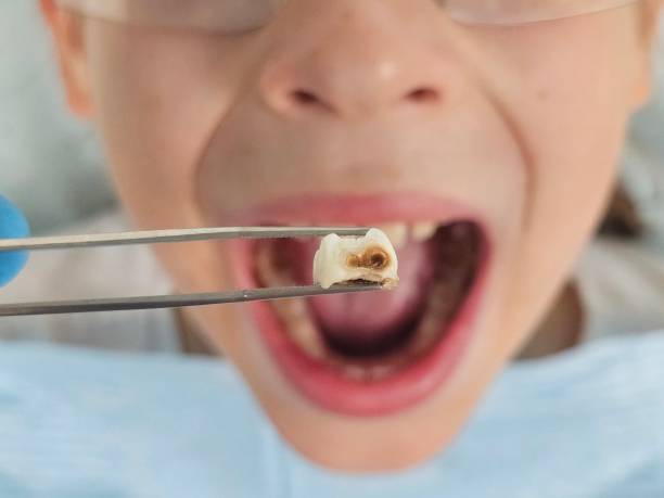 Best Emergency Tooth Extraction in Willow Grove, TX
